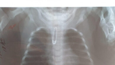 Photo of Булавка застряла в горле 3-месячной малышки в Шымкенте